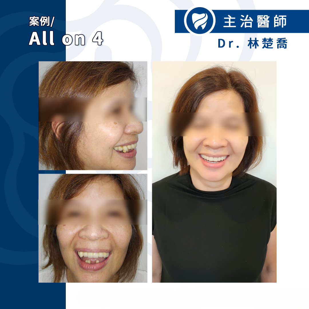 活動假牙改All on 4