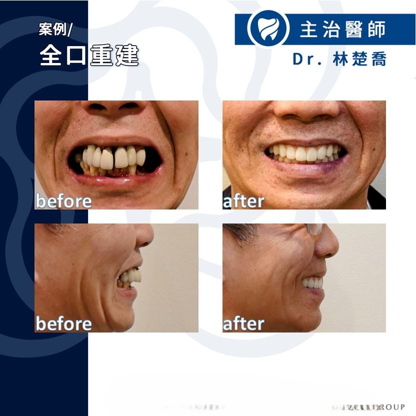 牙周病使用All on 4