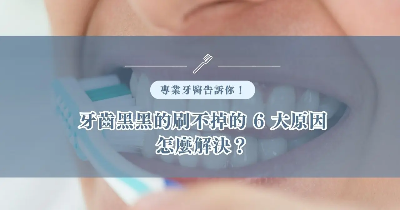 牙齒黑黑的刷不掉的 6 大原因怎麼解決？專業牙醫告訴你！