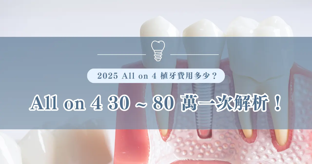 2025 All on 4 植牙費用多少？ All on 4 30~80 萬一次解析！
