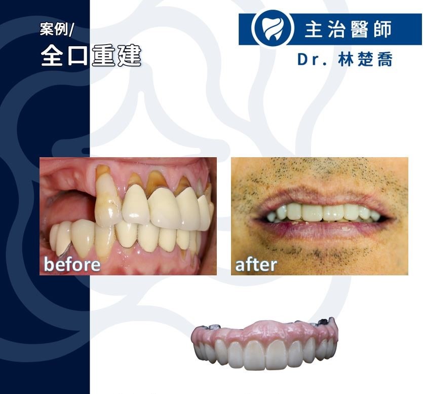 噬合植牙案例 2 ：全口重建