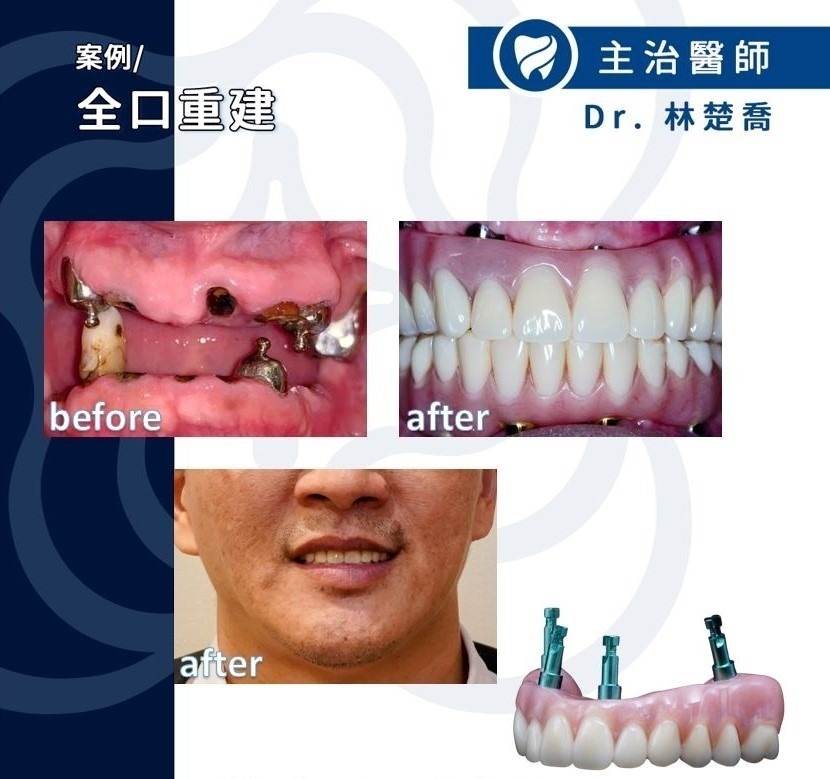 噬合植牙案例 3 ：全口重建