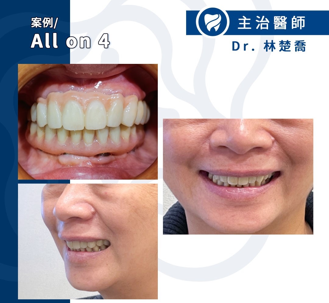 噬合植牙案例 4 ：All on 4 植牙